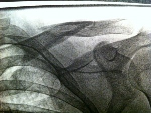 Scales' broken collar bone